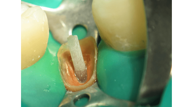 Востановление зуба штифтом после коррекции десны