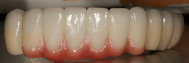 Металлокерамические коронки на зубах верхней челюсти