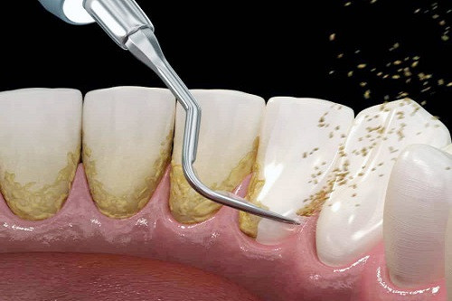 Зубной камень: особенности данной патологии