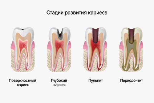 Какие болезни зубов встречаются чаще всего?