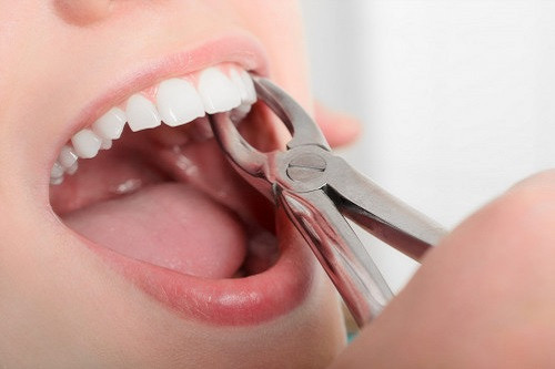 Какие бывают осложнения после удаления зубов