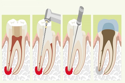 Можно ли удалить поврежденные зубы без боли